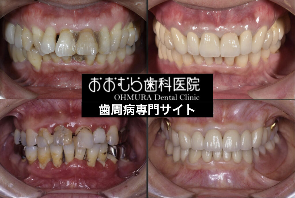 下関市のおおむら歯科医院　歯周病の説明ページ。　歯周外科手術、セラミック、矯正、インプラントを用いて、再生を行なった。